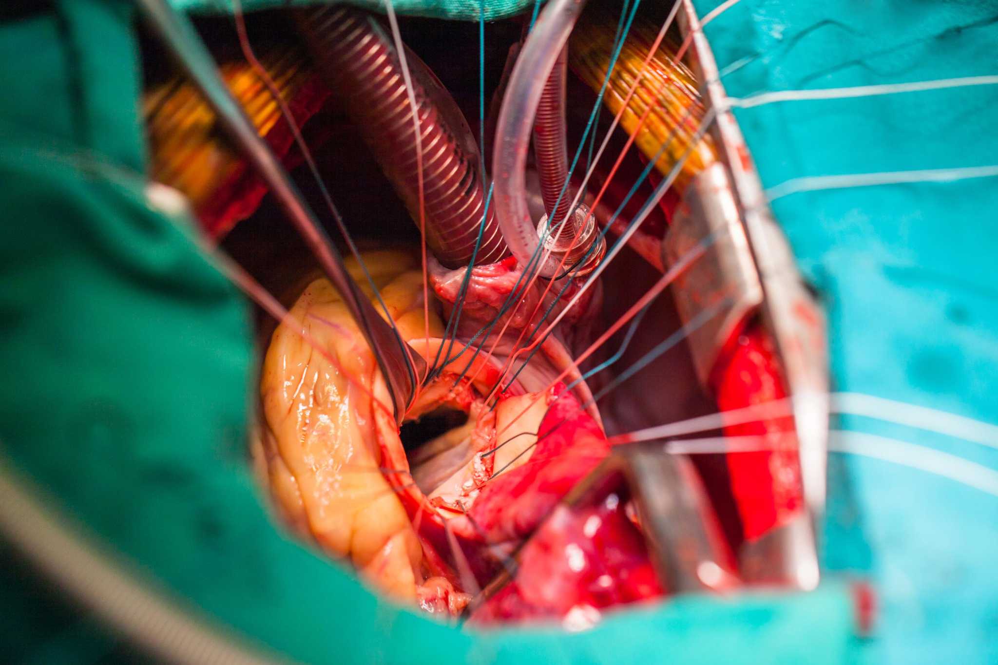 Kalp kapakçığı değiştirme ameliyatı