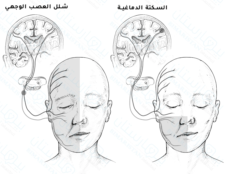 الفرق بين السكتة الدماغية وشلل العصب الوجهي