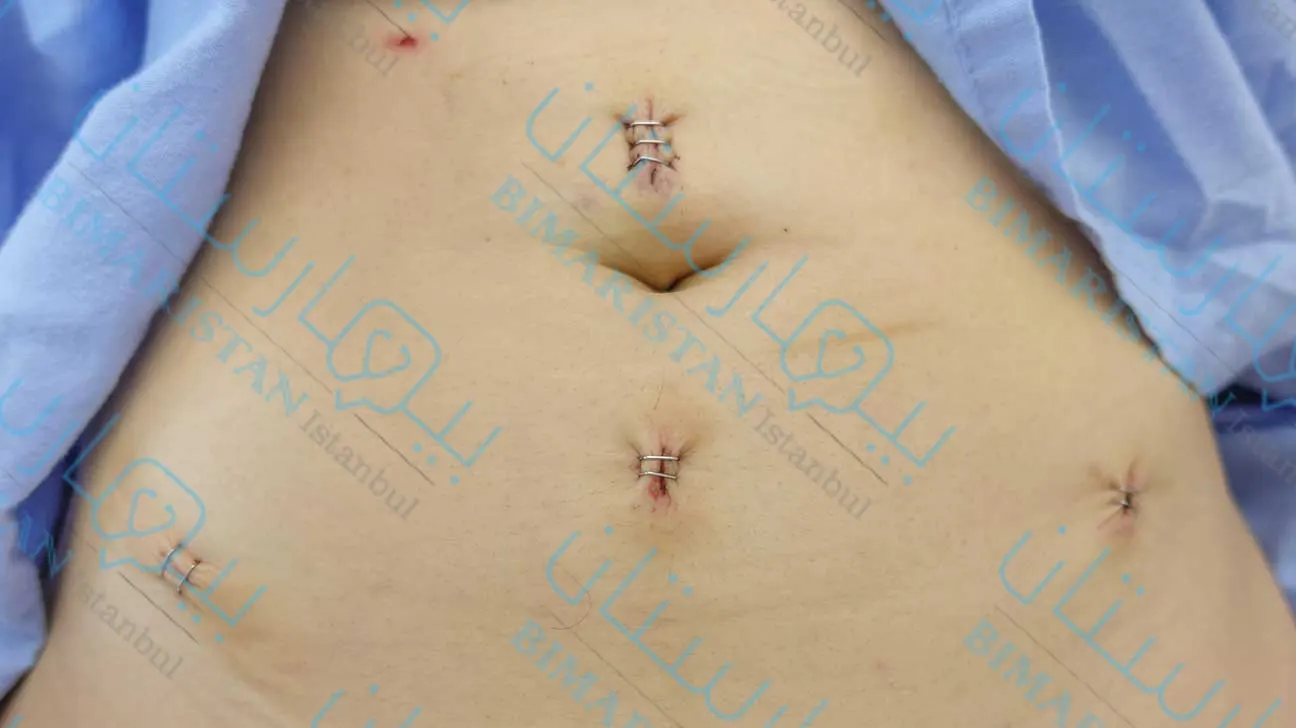 A picture of the surgical scars after laparoscopic uterine myomectomy and the extent of the effect of these scars on the aesthetic aspect