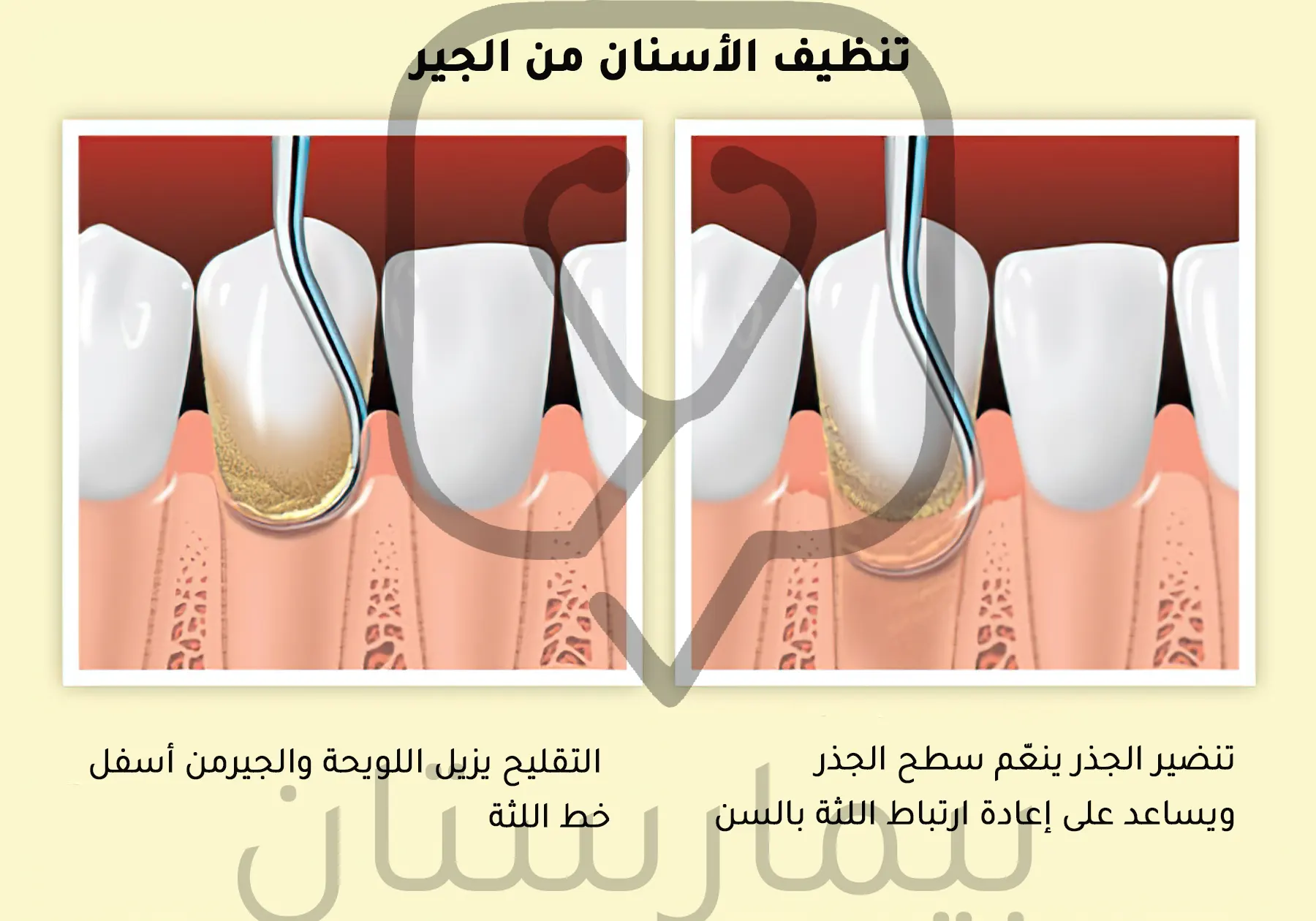 Teeth scaling and root rejuvenation