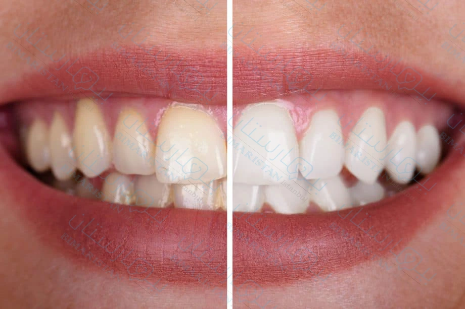 على اليسار تبدو الأسنان أغمق قبل التبييض وعلى اليمين نراها ذات لون أفتح نتيجة التبييض