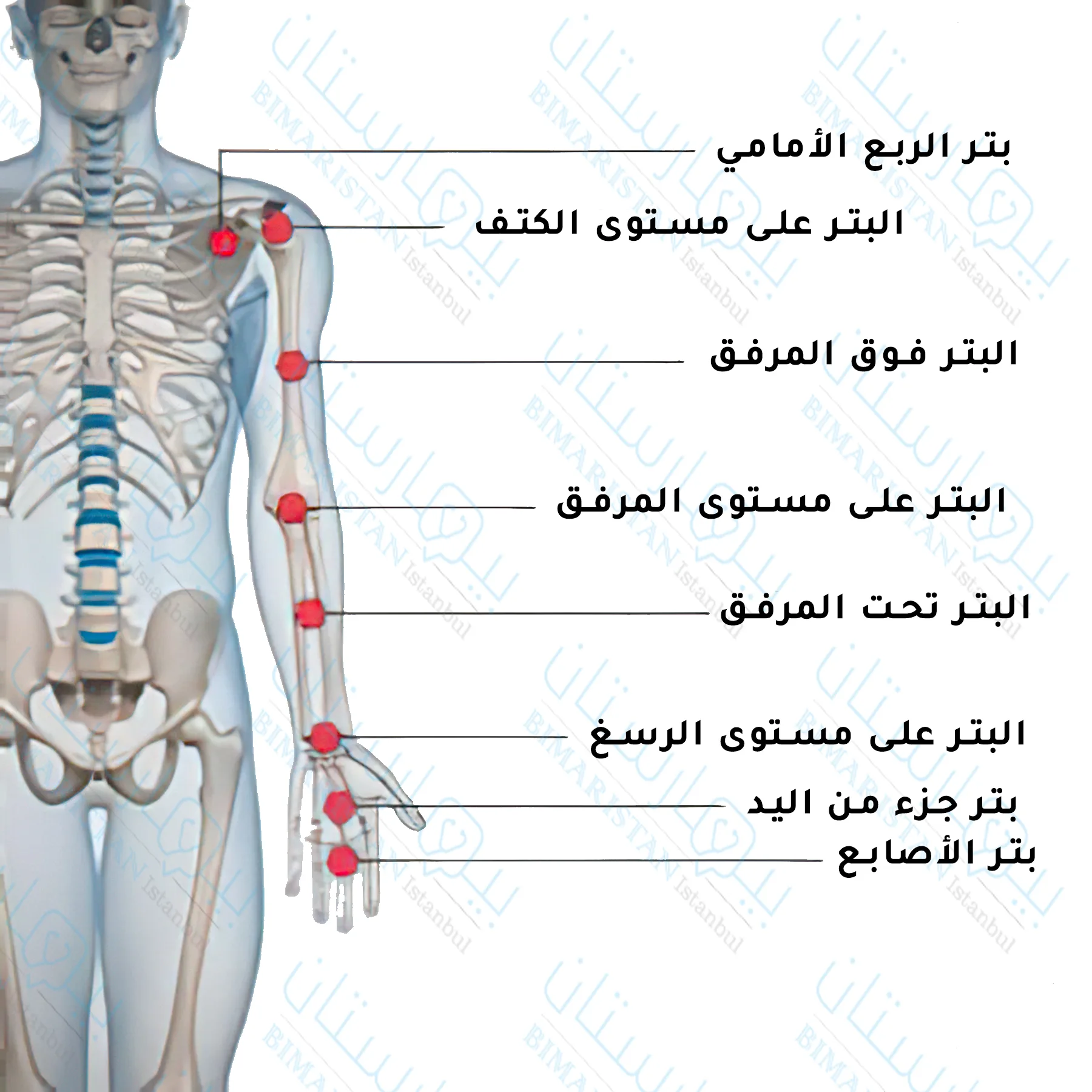 Picture of the levels of the amputation process in the upper extremity
