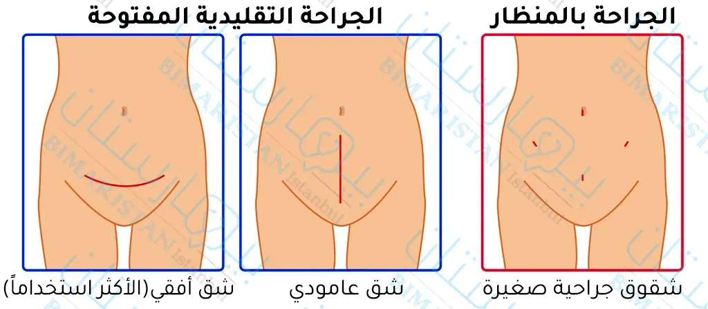 A picture of the different surgical incisions through which the uterine myoma can be removed