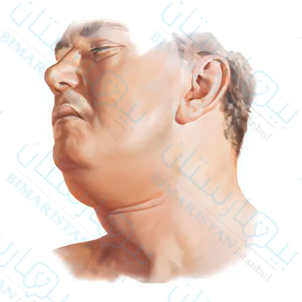 Swelling behind the chin due to Ludwig's angina