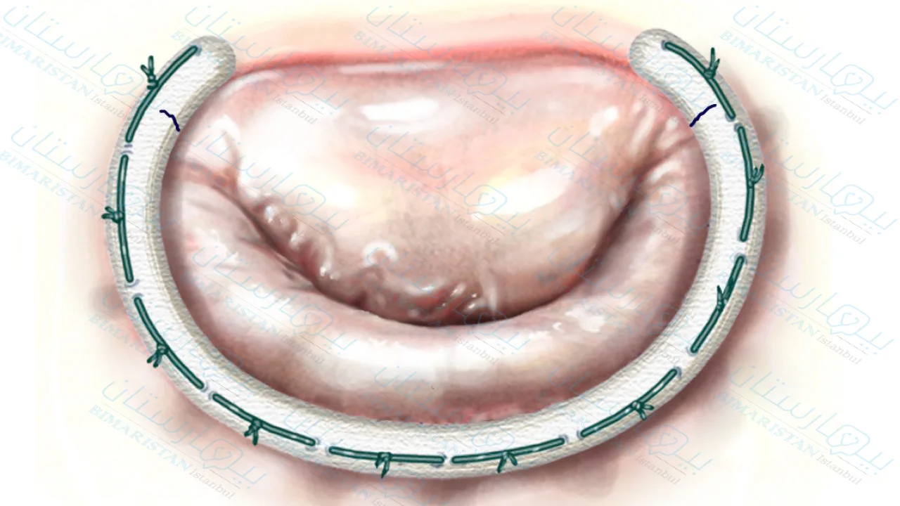Mitral valve repair is performed using an incomplete annulus to support its fulcrum