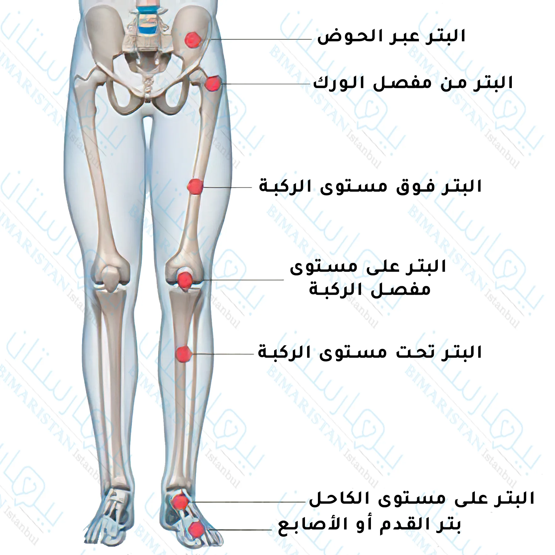 A picture of the lower limbs in humans showing the levels of the amputation process