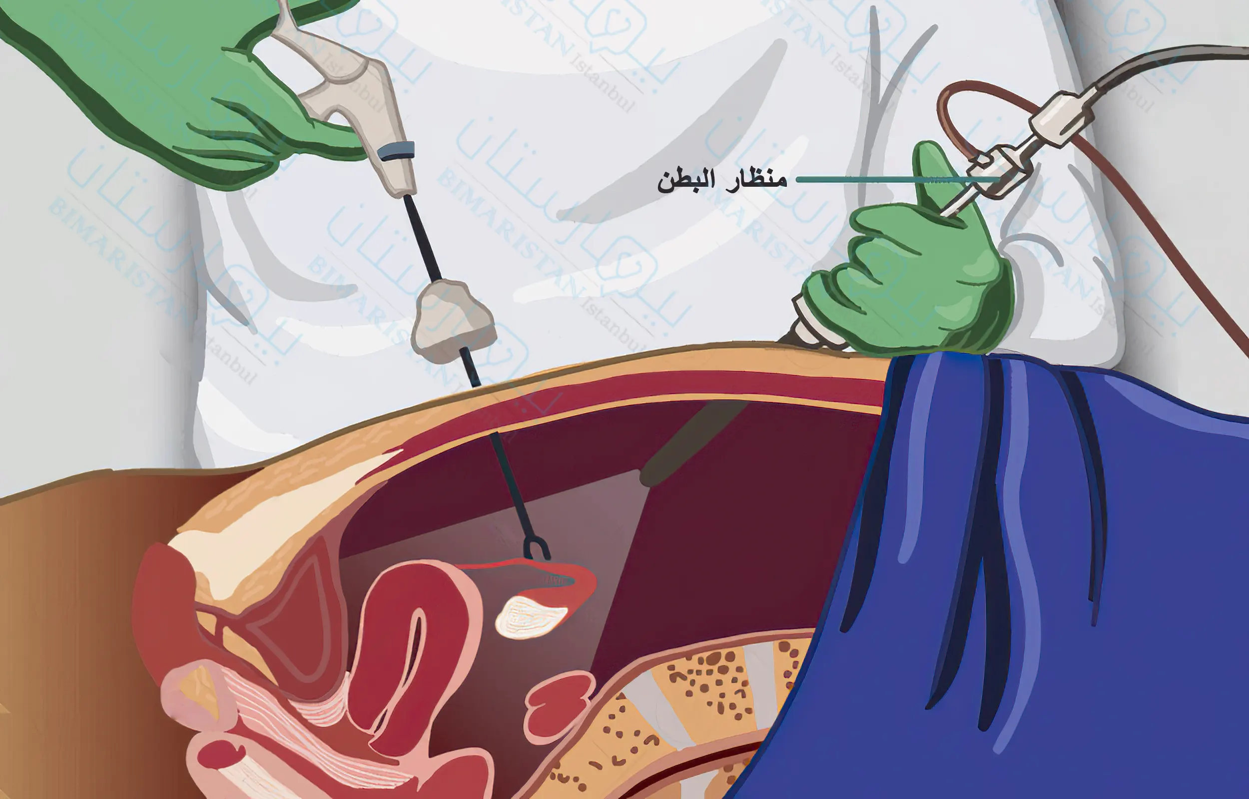 A picture of a laparoscopic uterine myomectomy