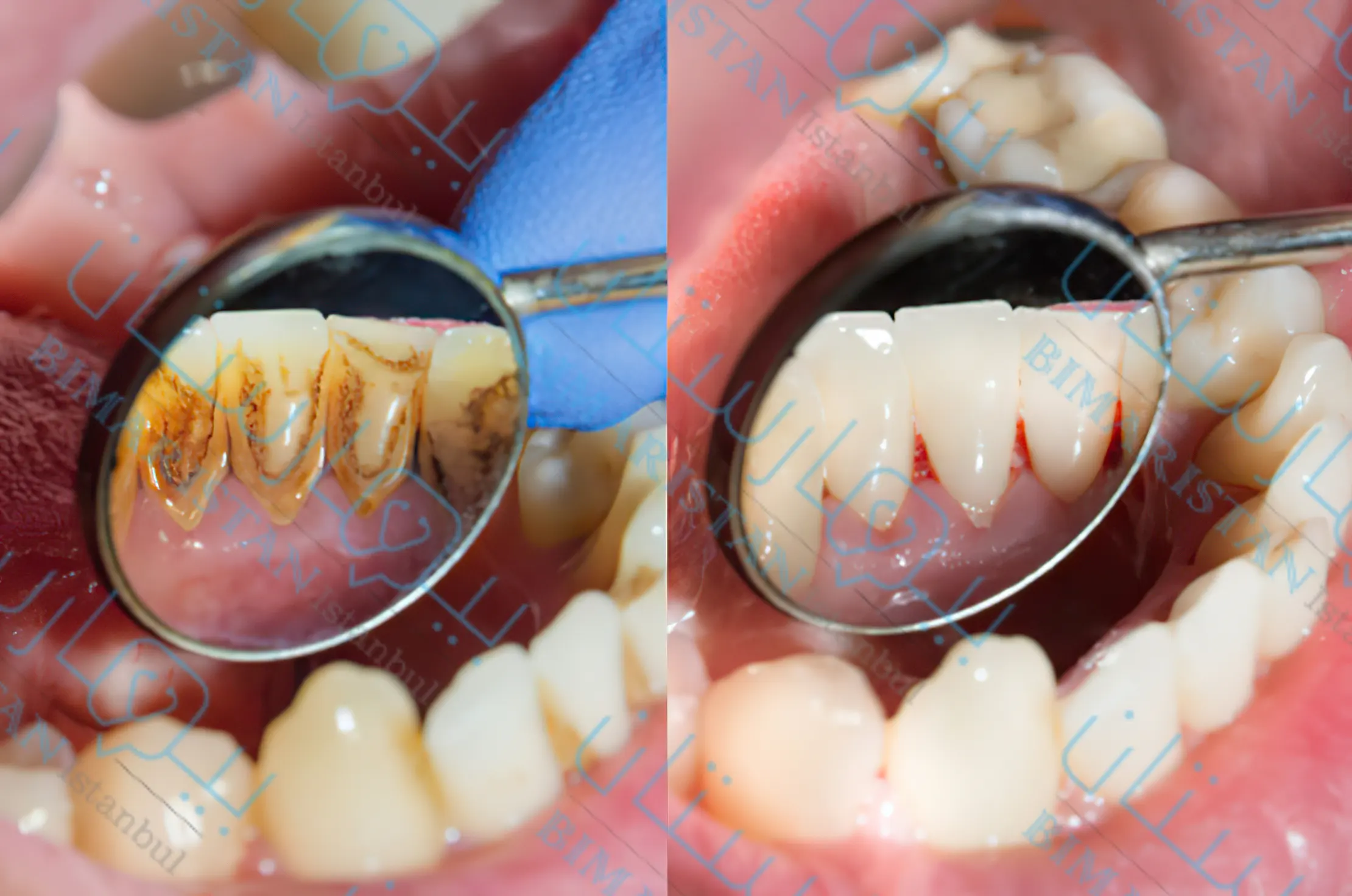 الصورة اليسرى تظهر ترسبات الجير على أعناق الأسنان وعلى اليمين تظهر الأسنان بعد تنظيفعا وإزالة الجير