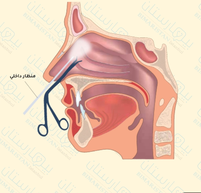 Functional endoscopy of the sinuses (FESS) for the treatment of sinusitis in Turkey