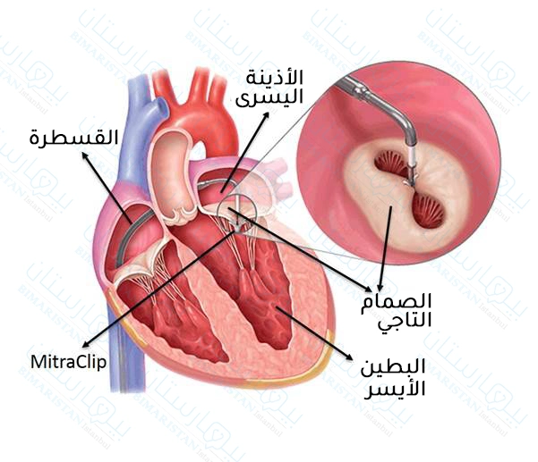 Mitral valve repair by ligation of its valves with a mitral valve clamp