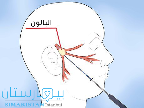 Treatment of inflammation of the fifth nerve by balloon