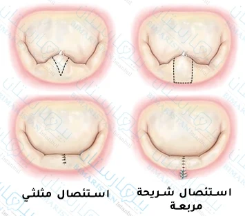 Note that the resection edges do not reach the valve annulus in a triangular resection while a portion of the valve annulus is resected when a square slice is excised