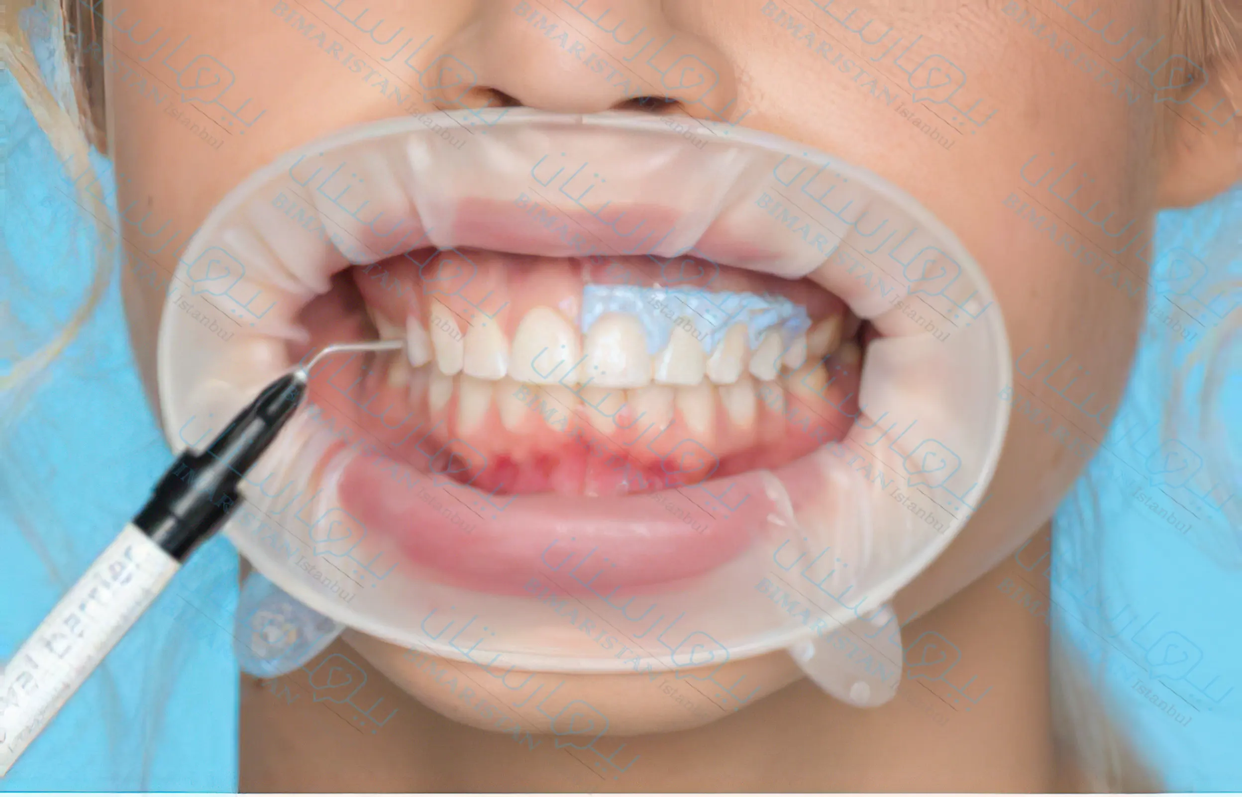 Laser teeth whitening method in Turkey using dental insulator