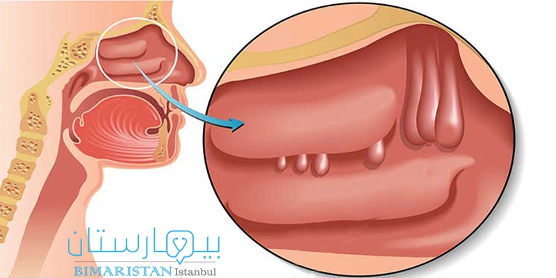 Nasal polyps in the nasal passages