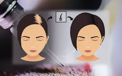 Türkiye'de kadınlara saç ekimi