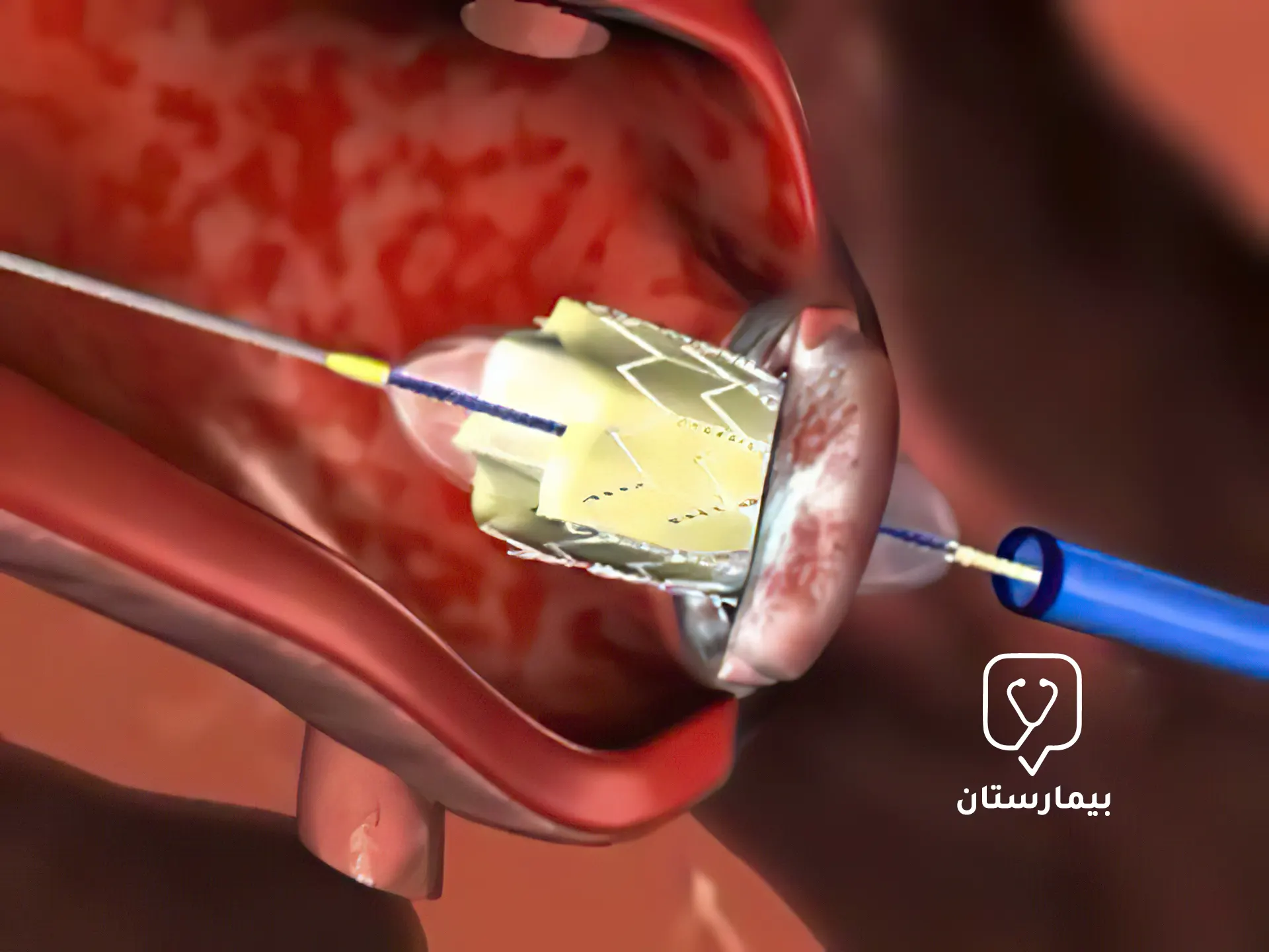 A catheter with an inflatable balloon on the end is inserted into the aortic valve