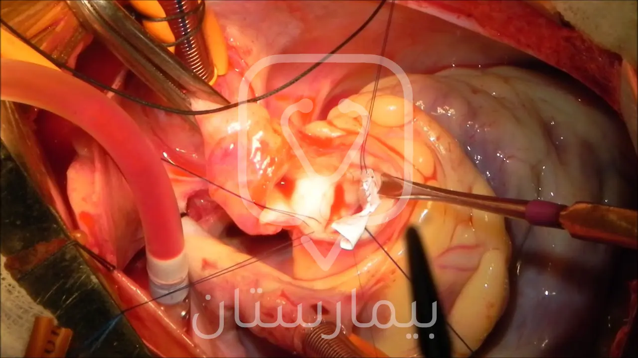 Aort kapak onarım süreci