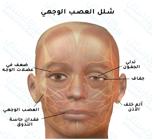 Symptoms of facial nerve paralysis