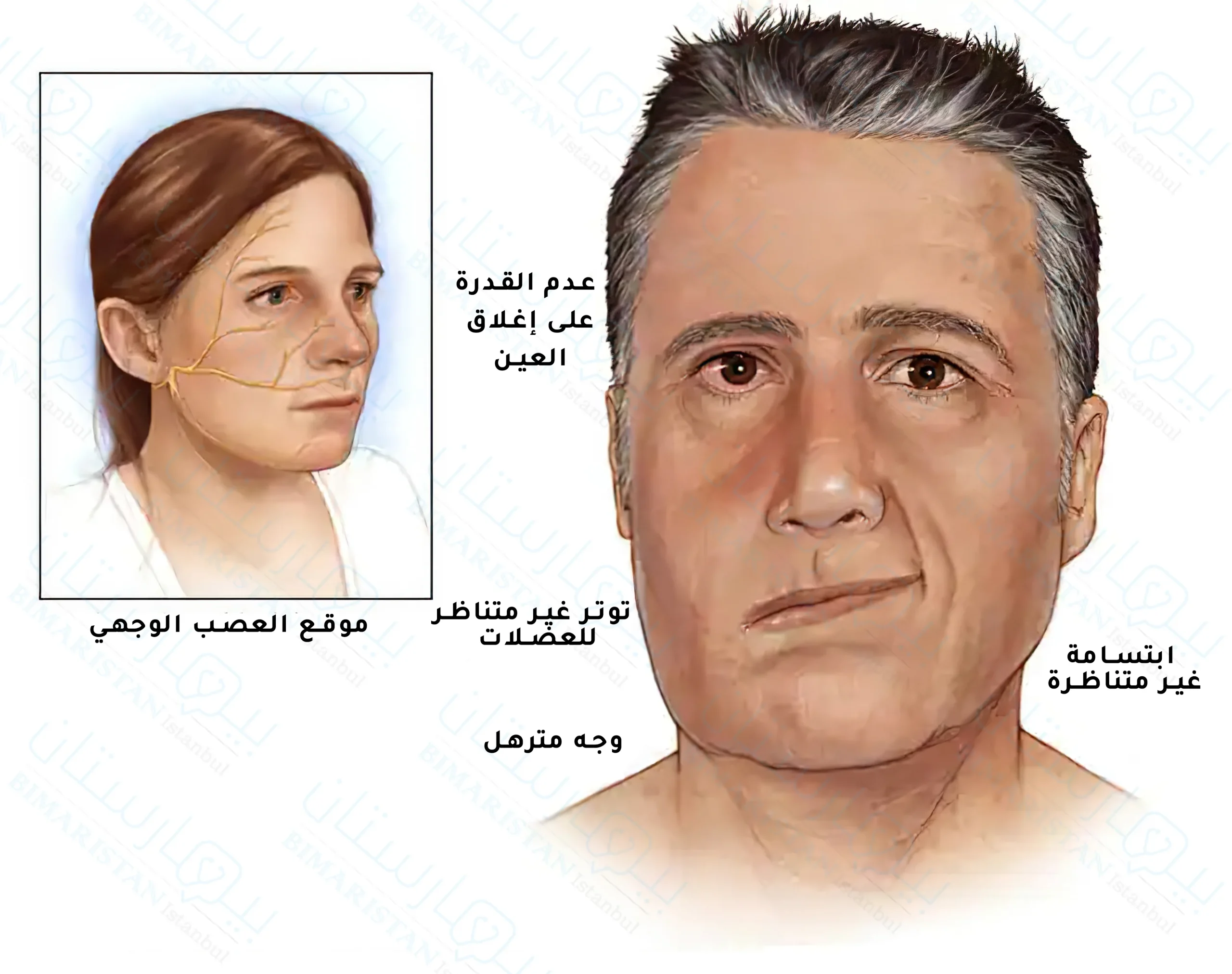 Facial nerve and paralysis
