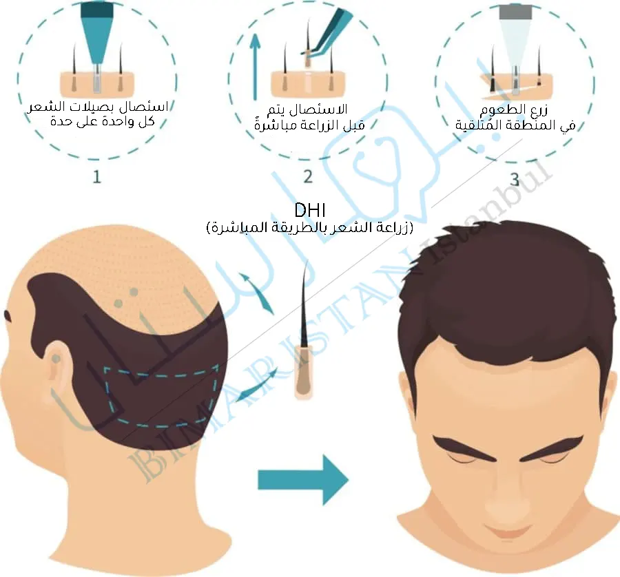 Hair transplantation for women in Turkey by the direct method