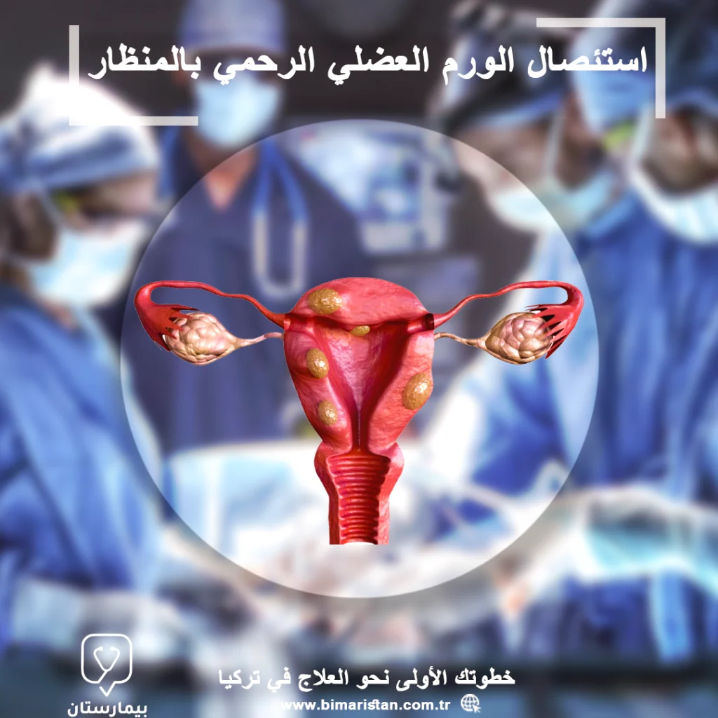 Laparoscopic Uterine Myomectomy