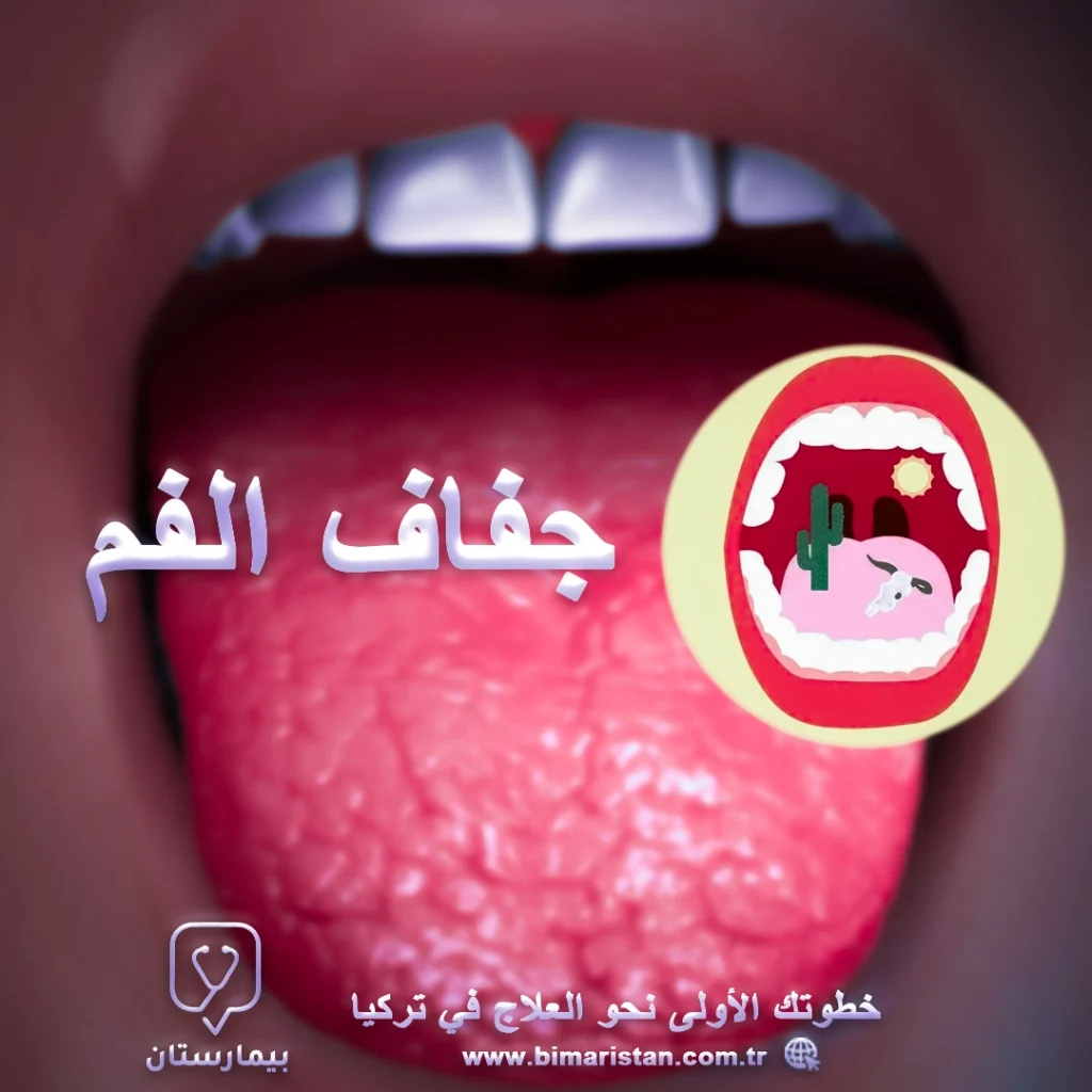 علاج جفاف الفم في تركيا
