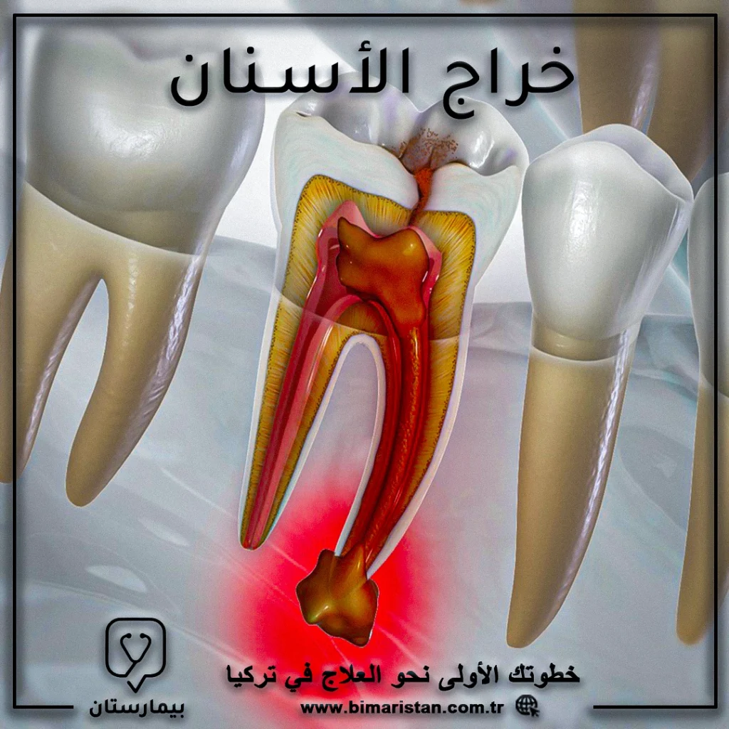 علاج خراج الأسنان في تركيا