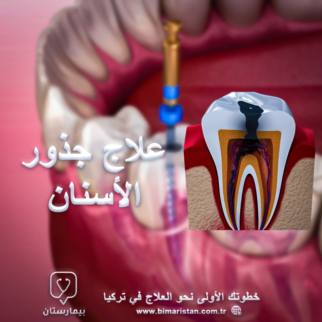 علاج-جذور-الأسنان