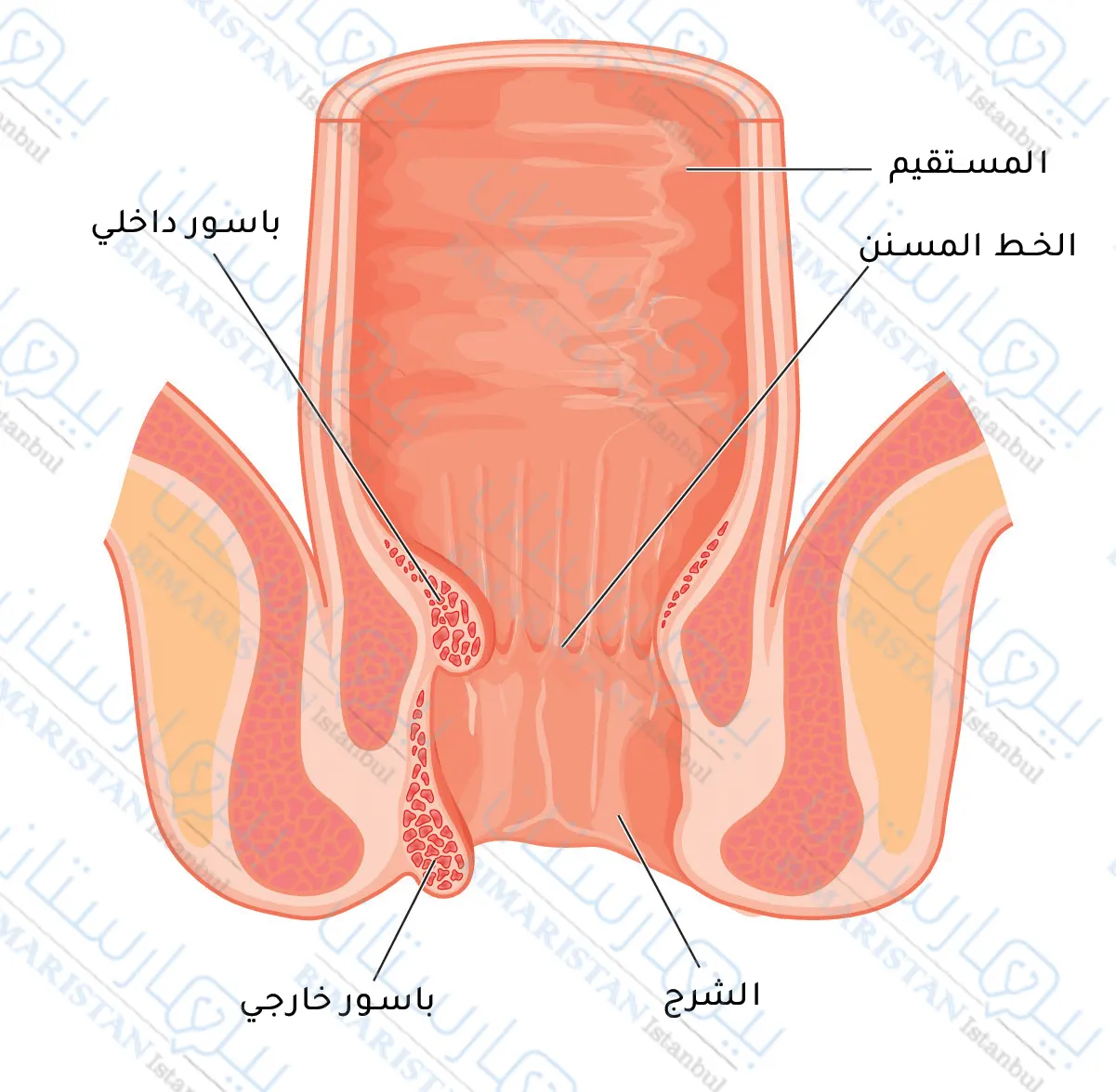 Internal hemorrhoids originate in the rectum or anal canal while external hemorrhoids can be seen around the anus