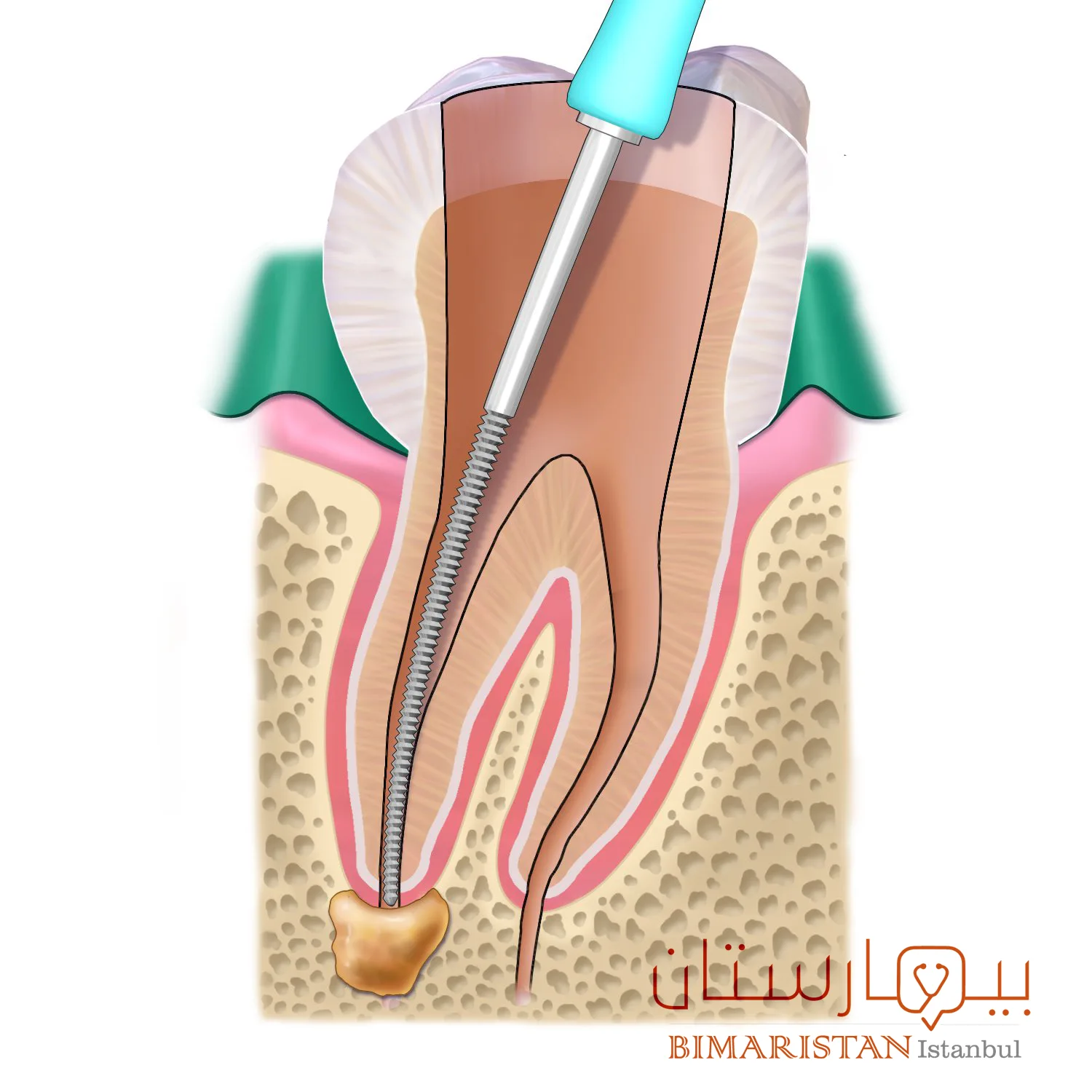 Cleaning the tooth canal with coolant