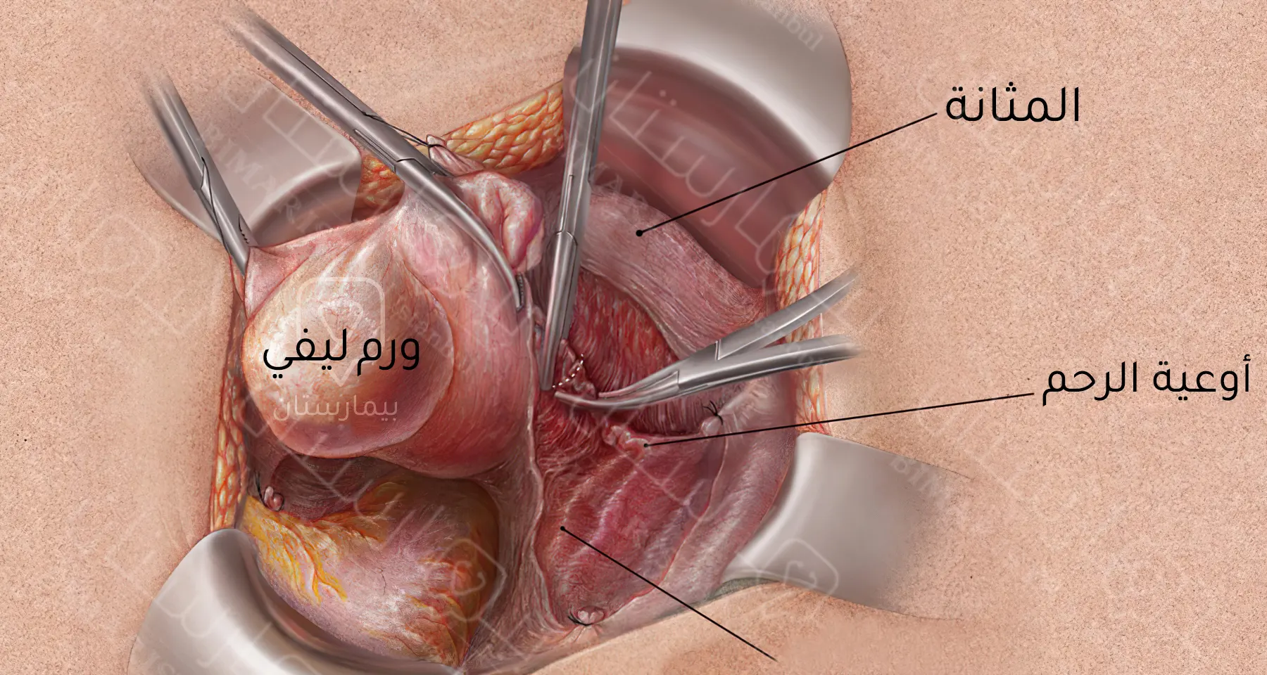 عملية استئصال الرحم عبر البطن بعد إجراء شق بطني عرضاني