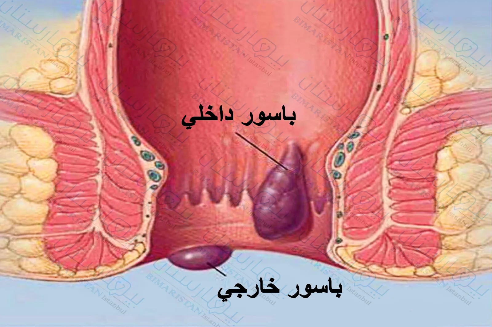 تتشكل البواسير الخارجية بالقرب من الشرج بينما تتشكل البواسير الداخلية بداخل المستقيم حتى الحافة الشرجية