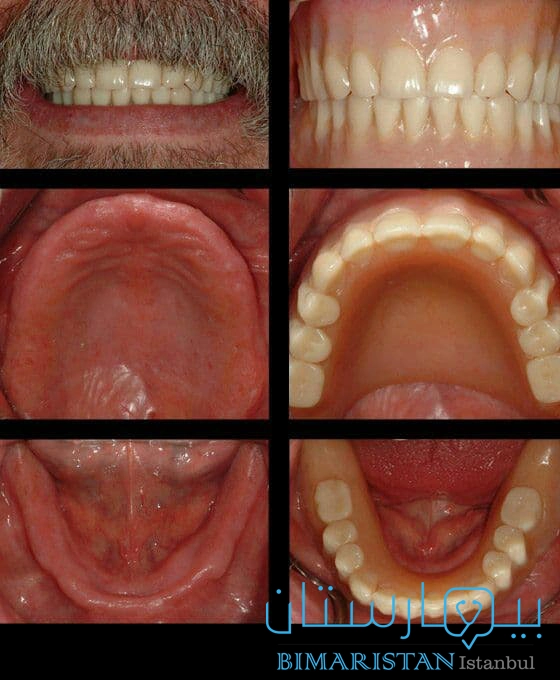 Before and after the installation of full dentures for a patient who has lost all his teeth