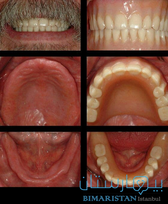 قبل وبعد تركيب أطقم الأسنان الكاملة لمريض لديه فقد بجميع الأسنان