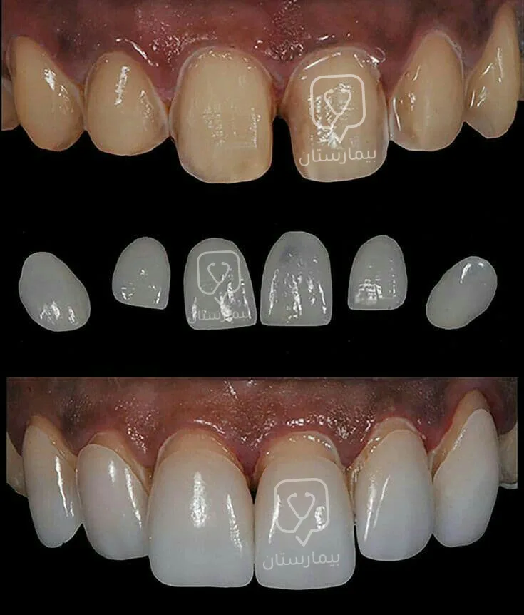 The picture shows how the teeth look after the veneers are installed