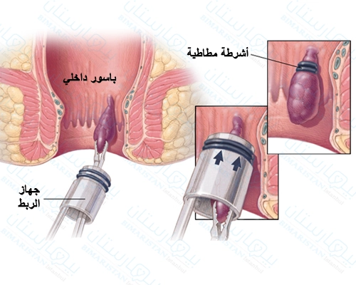 يقوم جهاز الربط بربط قاعدة الباسور الداخلي بالشريط المطاطي لقطع التروية الدموية عنه