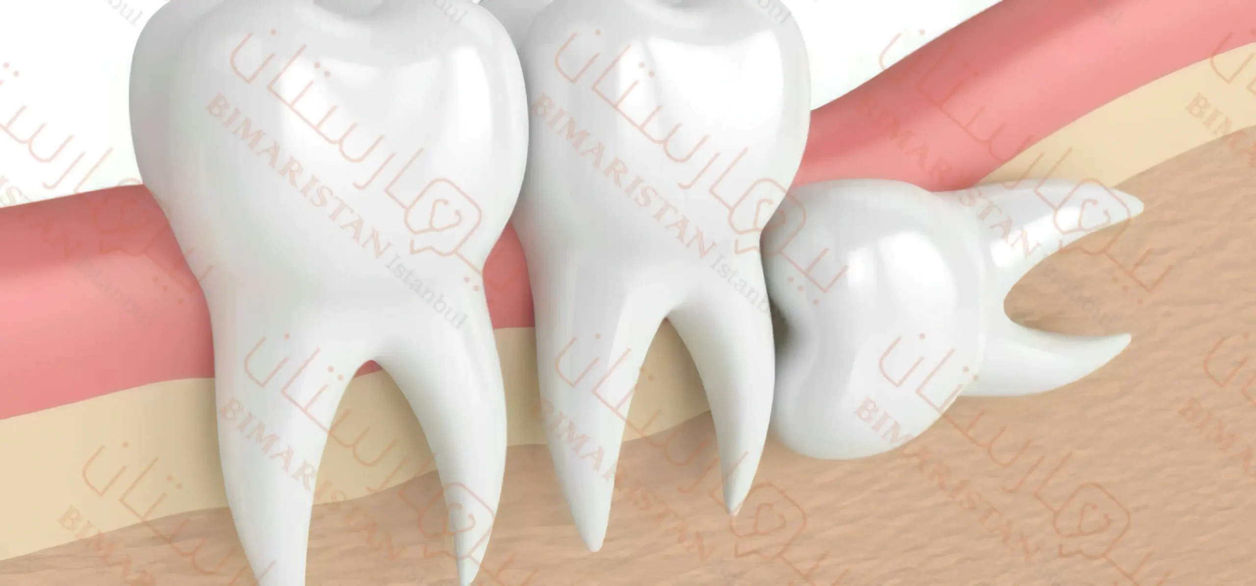 Wisdom tooth extraction in Turkey