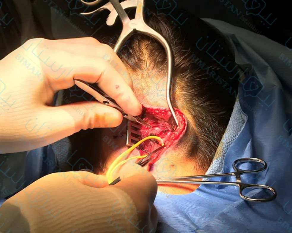 تم إجراء الشق الجراحي في جراحة الصداع النصفي لهذا المريض في فروة الرأس