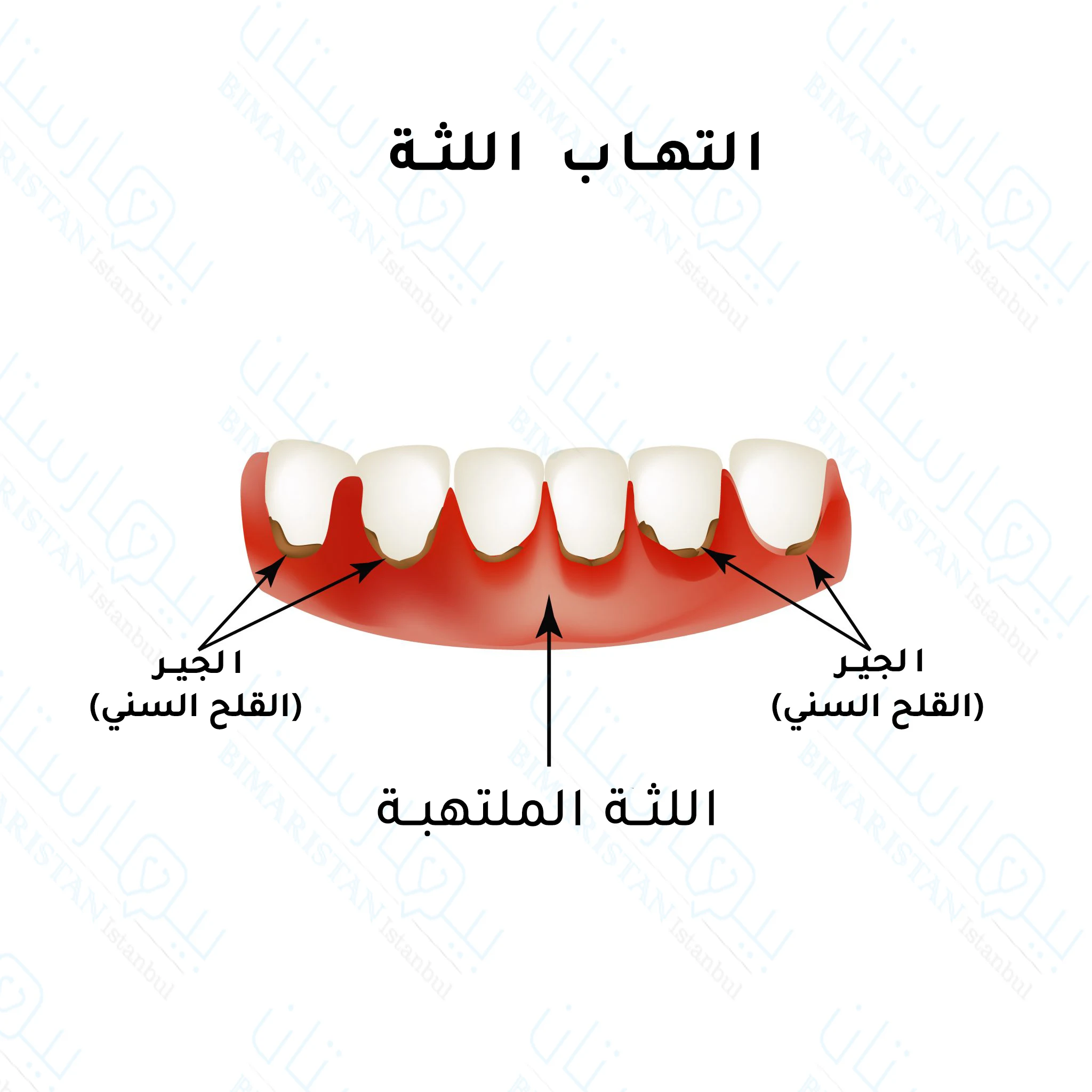 علاج التهاب اللثة في تركيا