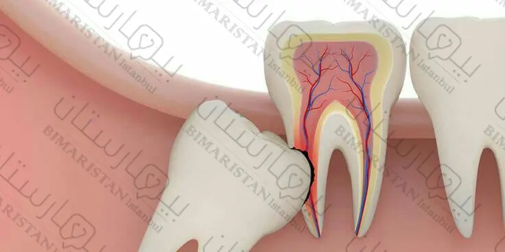 خلع ضرس العقل في اسطنبول