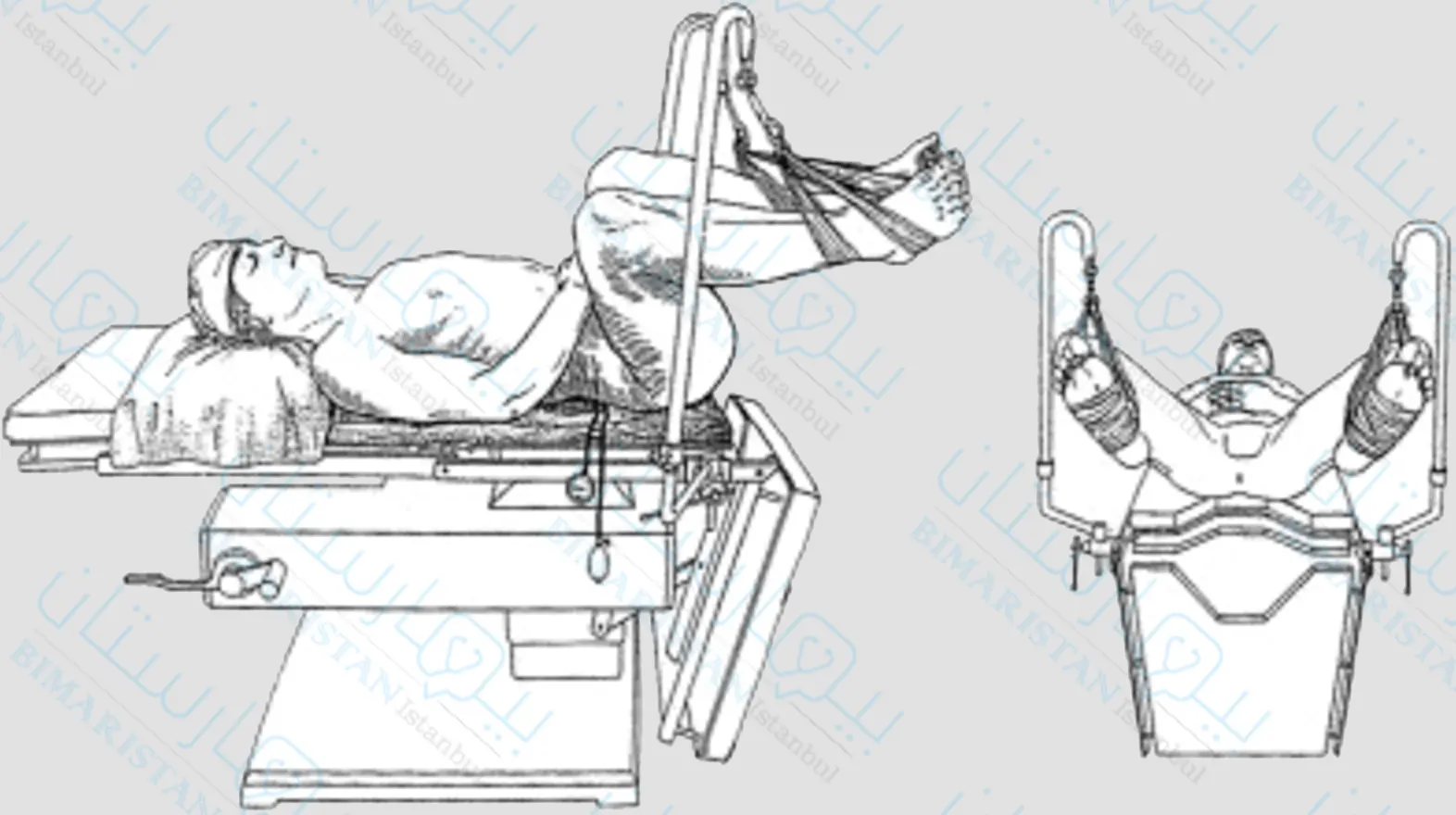 يستلقي المريض بوضعية تفتيت الحصاة لإجراء عملية البواسير بالليزر