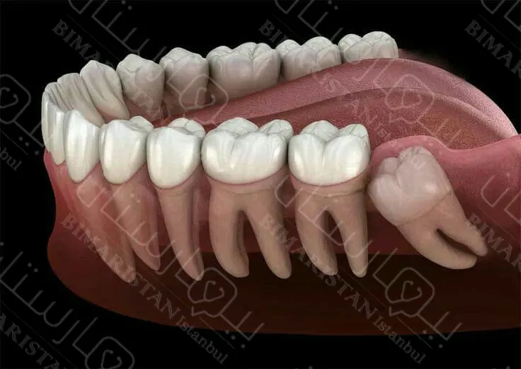 Wisdom tooth extraction in Istanbul
