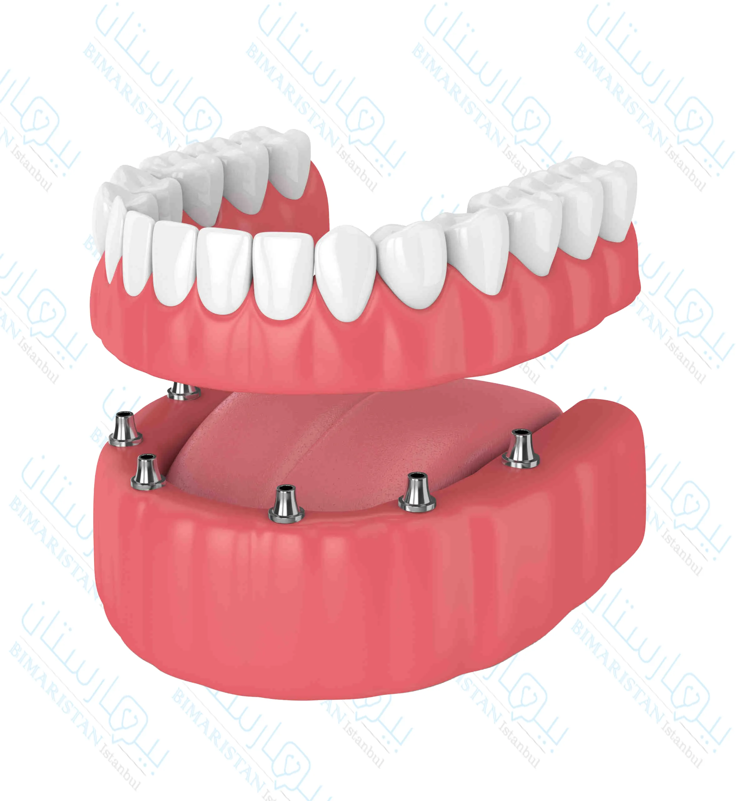 Partial dentures supported by implants implanted into the jawbone