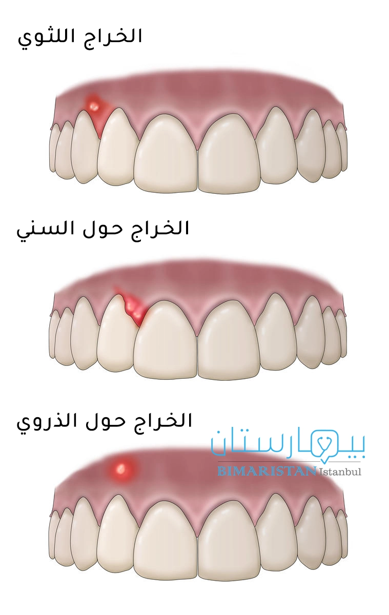 أنواع خراج الأسنان