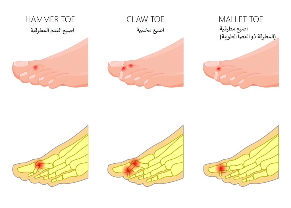 أنواع أصابع القدم المطرقية