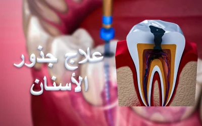 متى تحتاج علاج جذور الأسنان وكيف يتم في تركيا؟