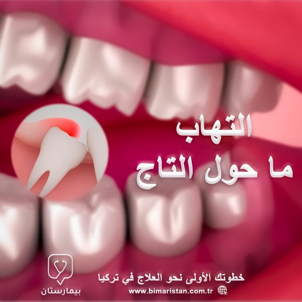 Treatment of inflammation around the crown of the teeth in Turkey