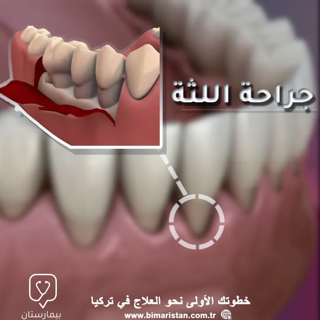 Türkiye'de periodontal cerrahi