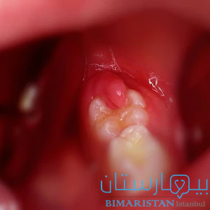Taçtaki azı dişlerinin üzerindeki periodontal raf