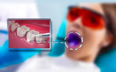 Types of laser dental treatment